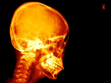Free Stock Photo of Xray of the skull