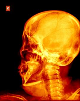 Free Stock Photo of Human Skull X-ray