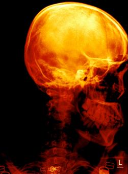 Free Stock Photo of A non angled lateral radiograph x ray of the skull
