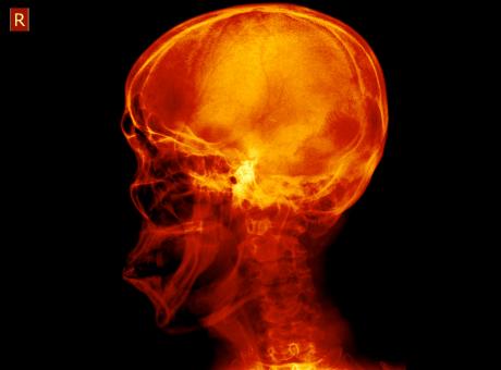 Free Stock Photo of Lateral Radiograph Xray of Human Skull