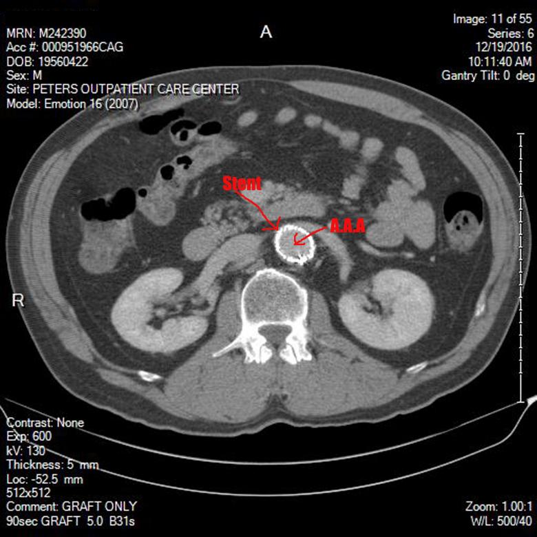 Free stock image of Abdominal aortic aneurysm created by rudy liggett