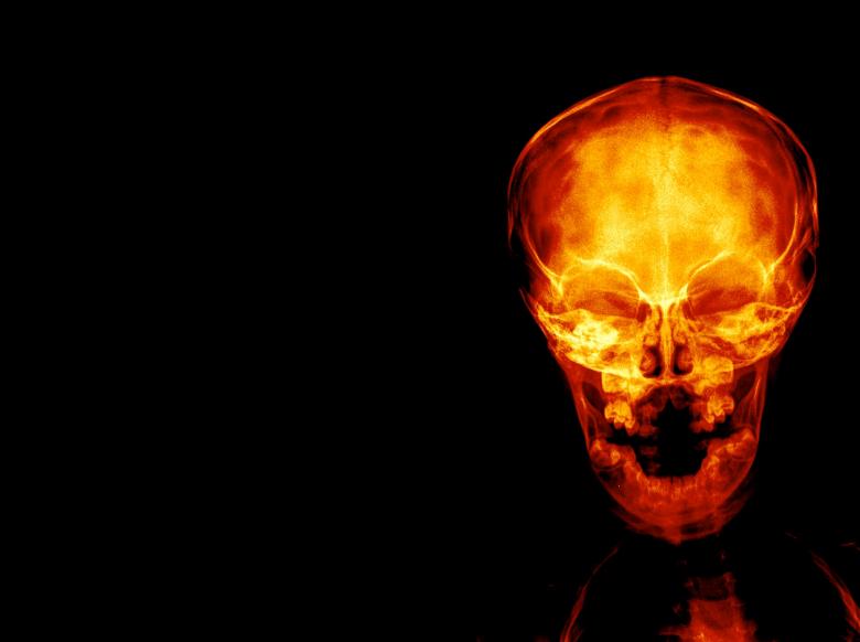 Free stock image of Radiograph X-ray of a Skull created by Sugiyatno