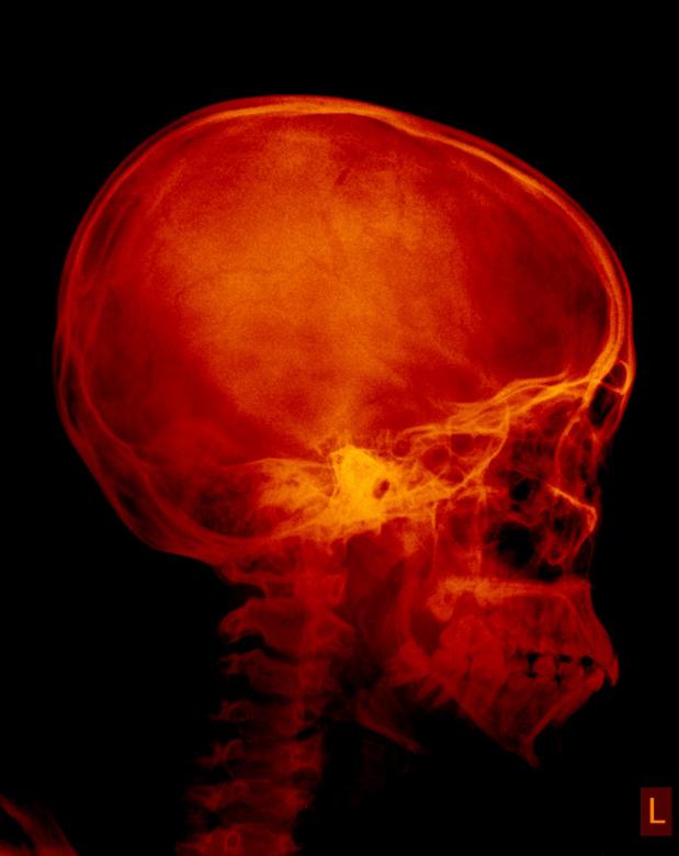 Free stock image of Non Angled Radiograph Human Skull created by Sugiyatno