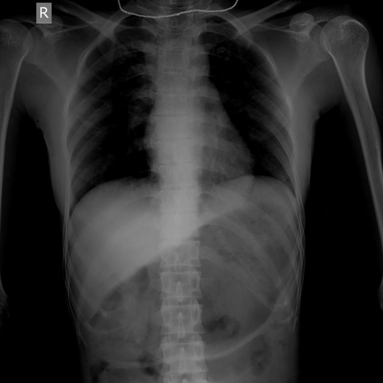 Free stock image of A human bones radiograph of thorax created by Sugiyatno